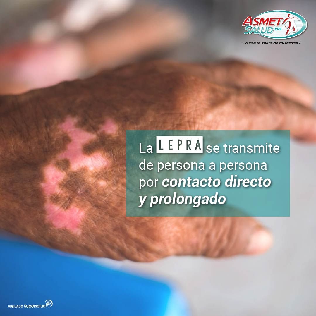 La Lepra NO es un mito, es una realidad, es una enfermedad aún vigente